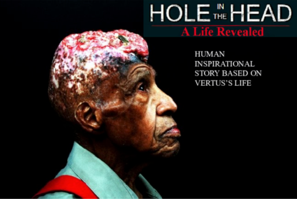 Film | Hole in the Head – The extraordinary life story of Vertus Hardiman